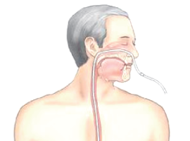 위루관, 비위관 삽입으로 입으로 식사를 못하는 경우